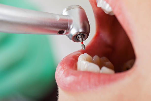 Best Chipped Tooth Repair Near Me  in Midlothian, VA